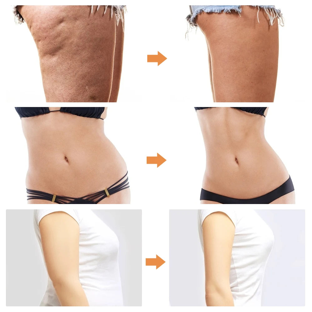 Liposuction Machine